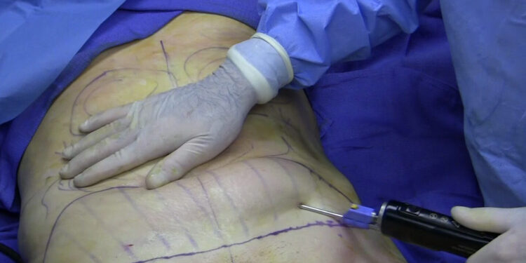 You’d avoid liposuction if you saw the BTS – Gospel musician