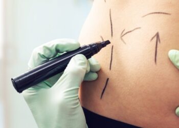 Here’s what they don’t tell you about liposuction