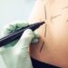 Here’s what they don’t tell you about liposuction